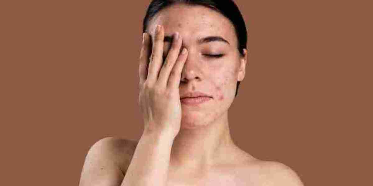Affordable Hyperpigmentation Treatments in London