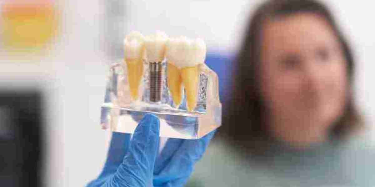 What Are the Options for Dental Implants in Stafford?